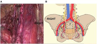 Pelvic Lymph Node Dissection in Penile Cancer With Inguinal Lymph Node Extranodal Extension: A Multicenter Experience